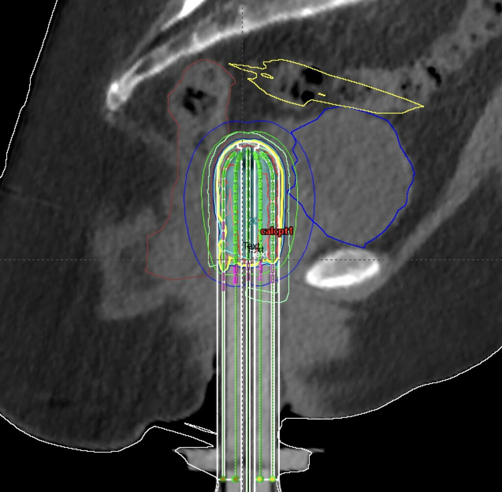 intracavitary brachytherapy